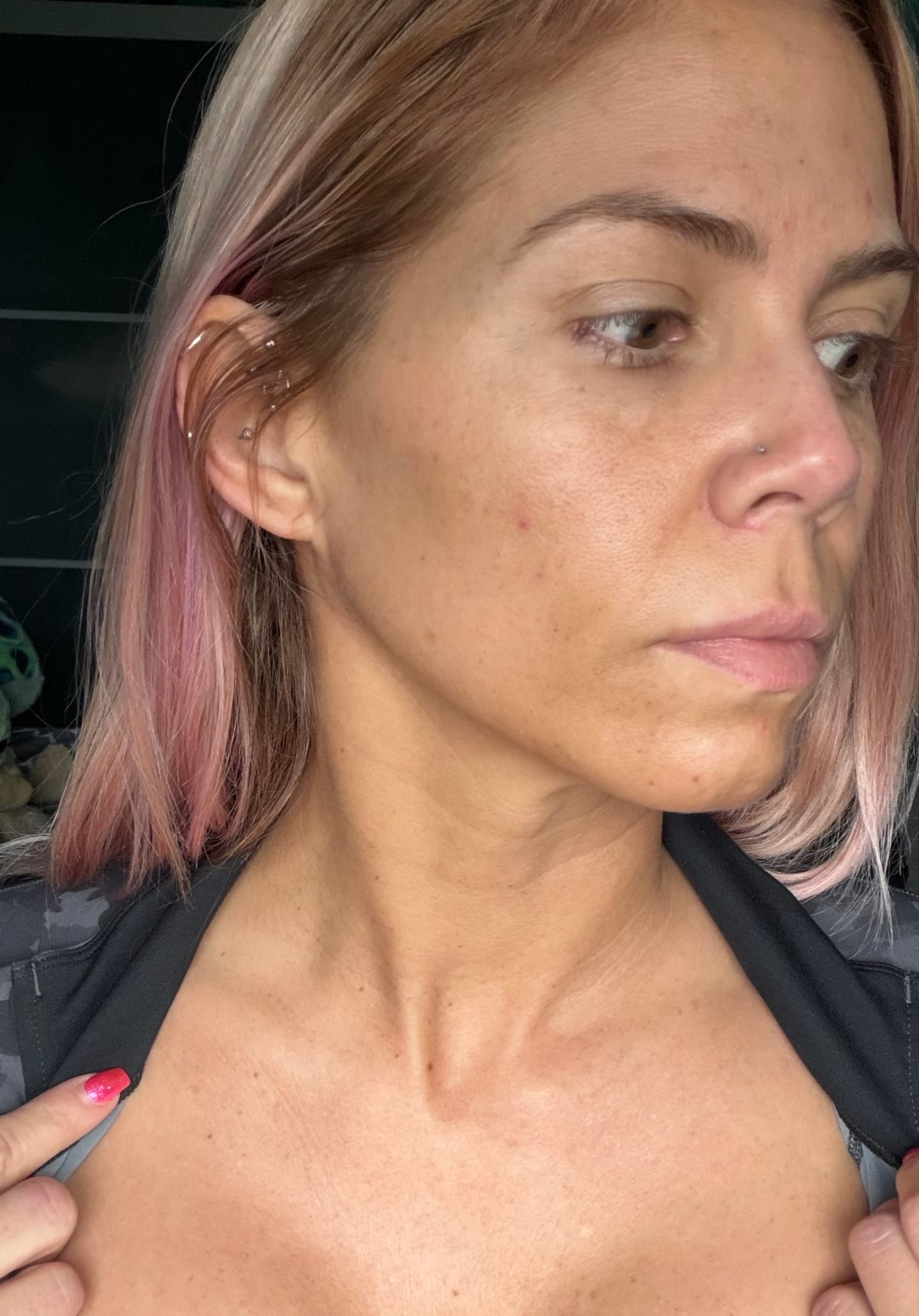 Facial skin before a VI Peel chemical peel treatment at Express Med Spa in Illinois, showing the pre-treatment complexion.