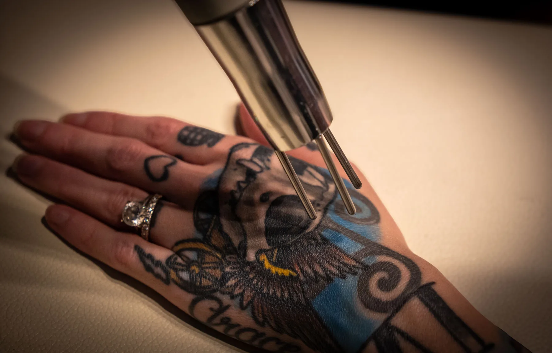 Laser tattoo removal on hand using medical-grade device at Express Med Spa; fading ink on wrist with visible precision pulse.