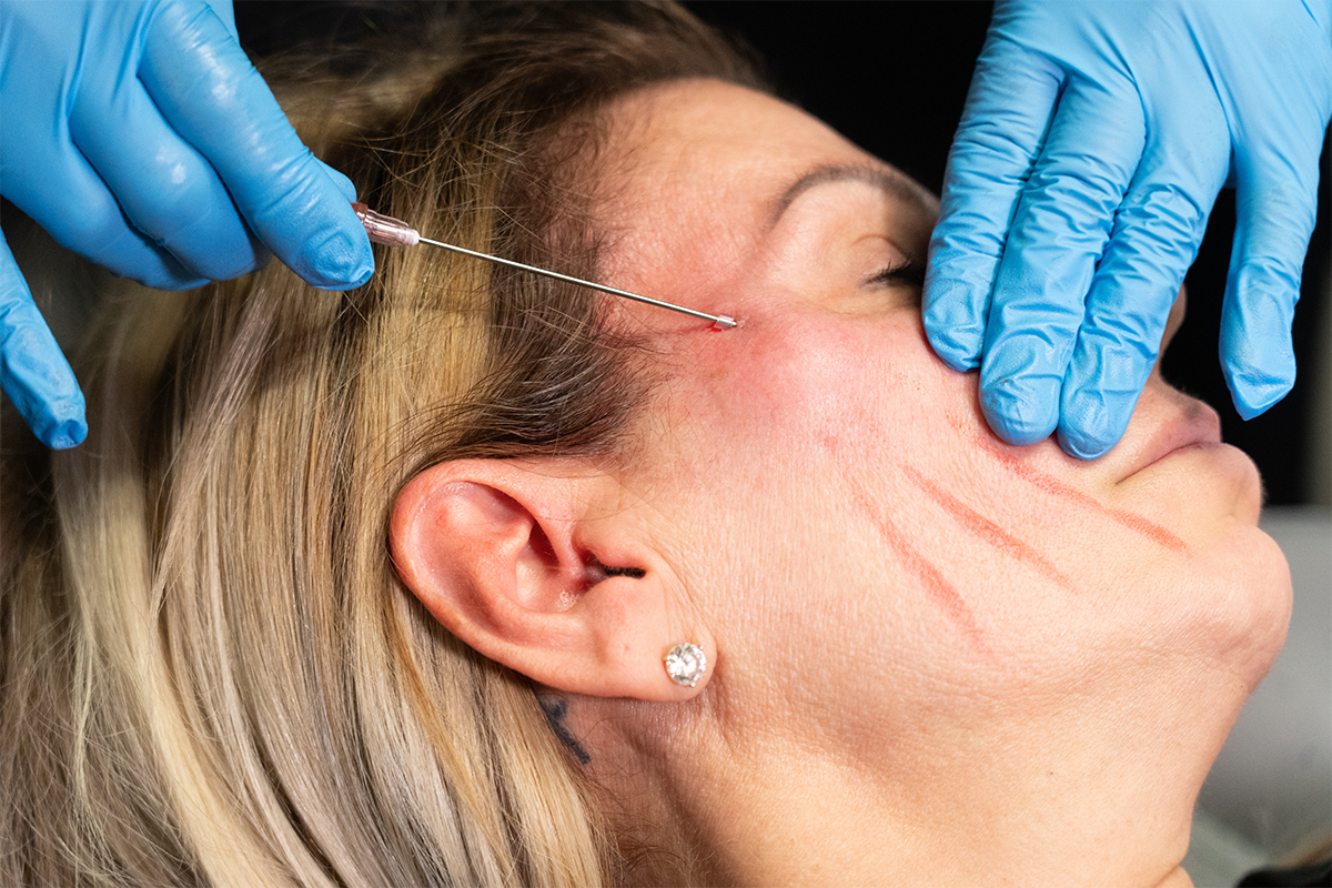 PDO threads supporting mid-face lift for natural volume and contour enhancement