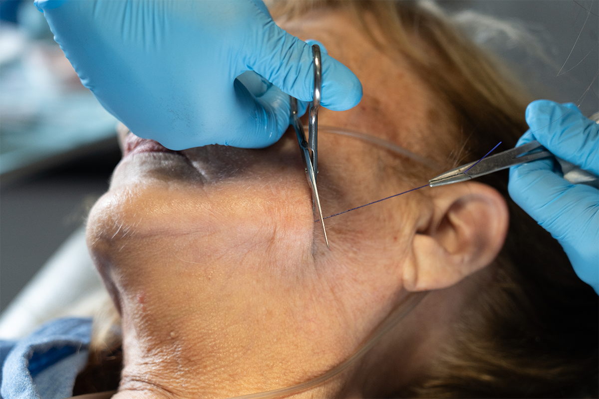 Lower face thread lift for jawline definition and sagging skin correction