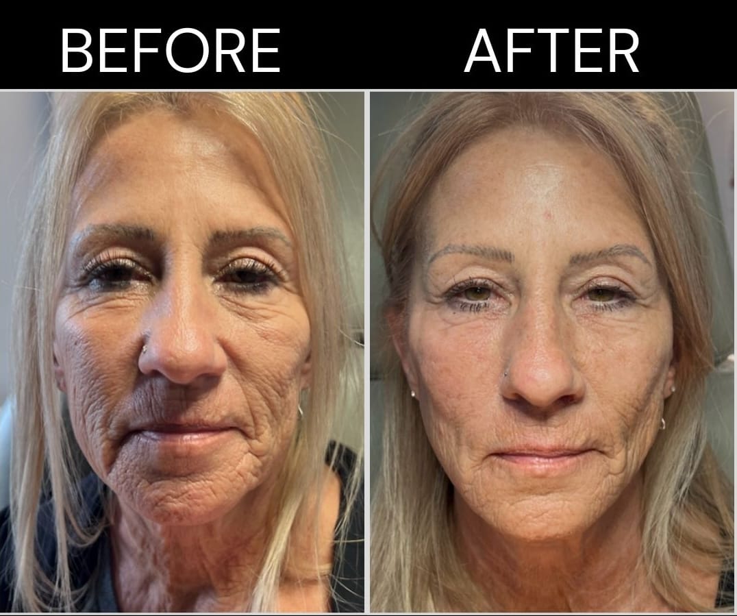 PDO Thread Jawline Lift La Grange
