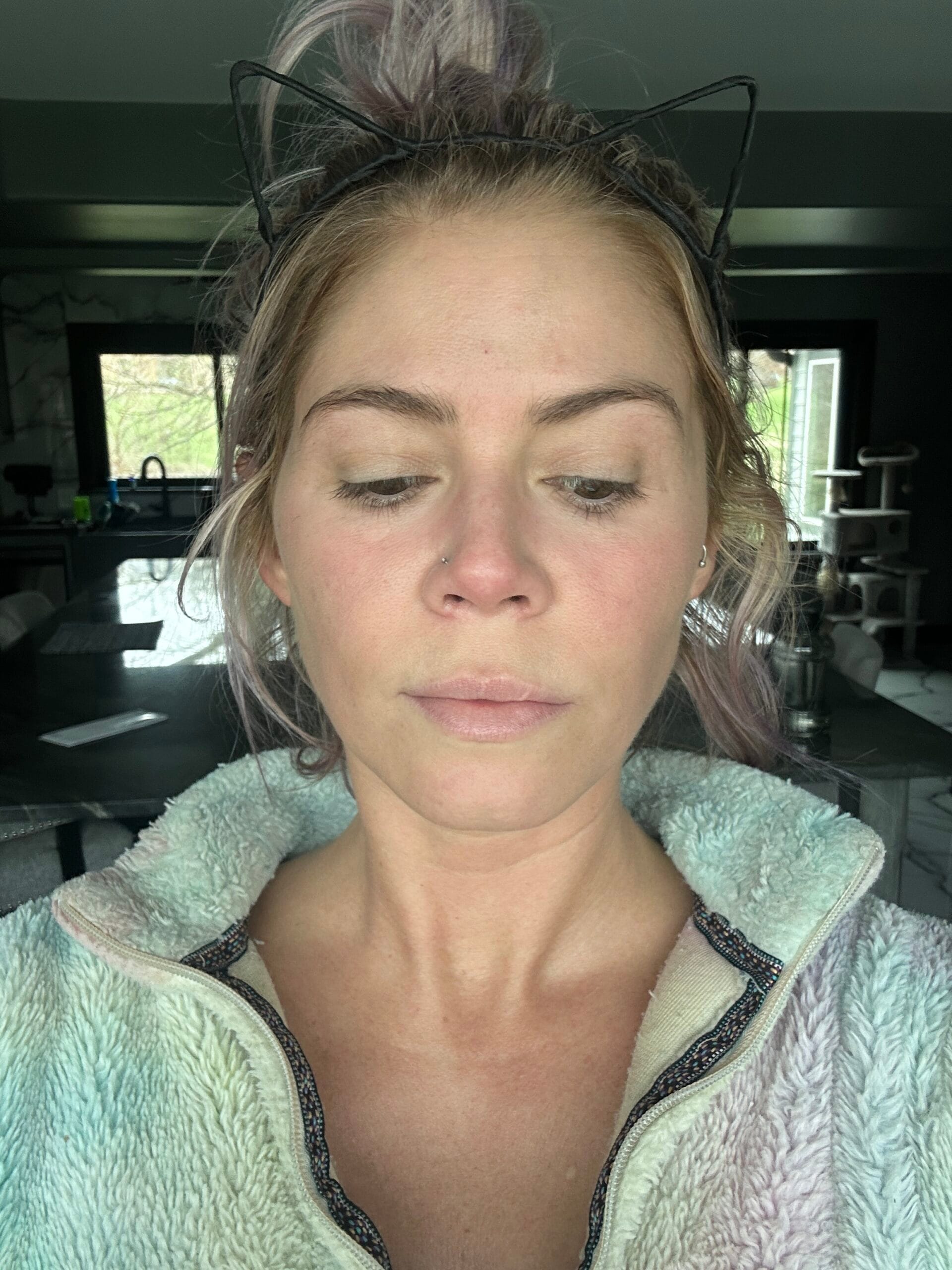 Featured image for “Chemical Peel Skin Resurfacing Result, IL”