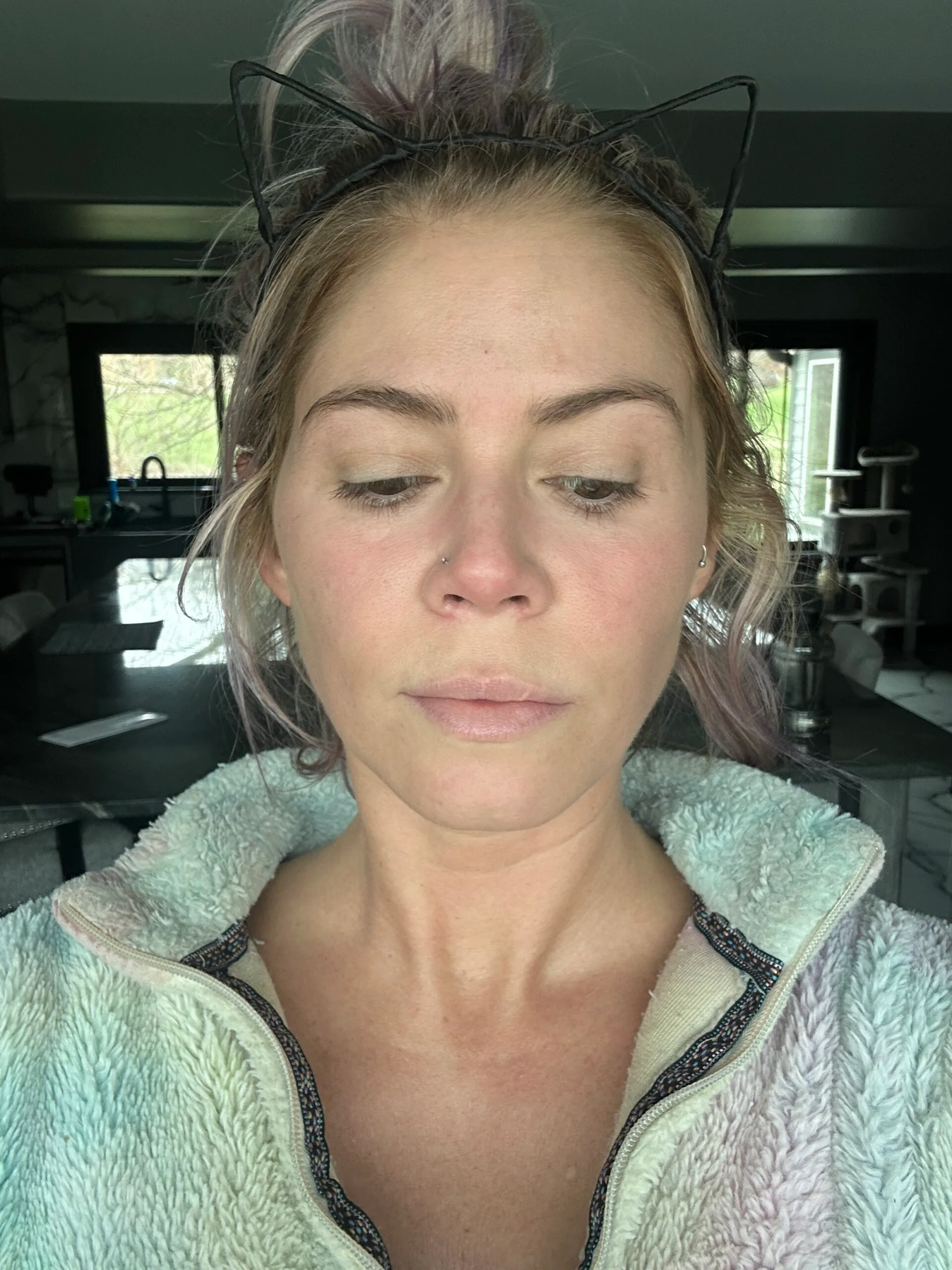 Featured image for “Chemical Peel Skin Resurfacing Result, IL”