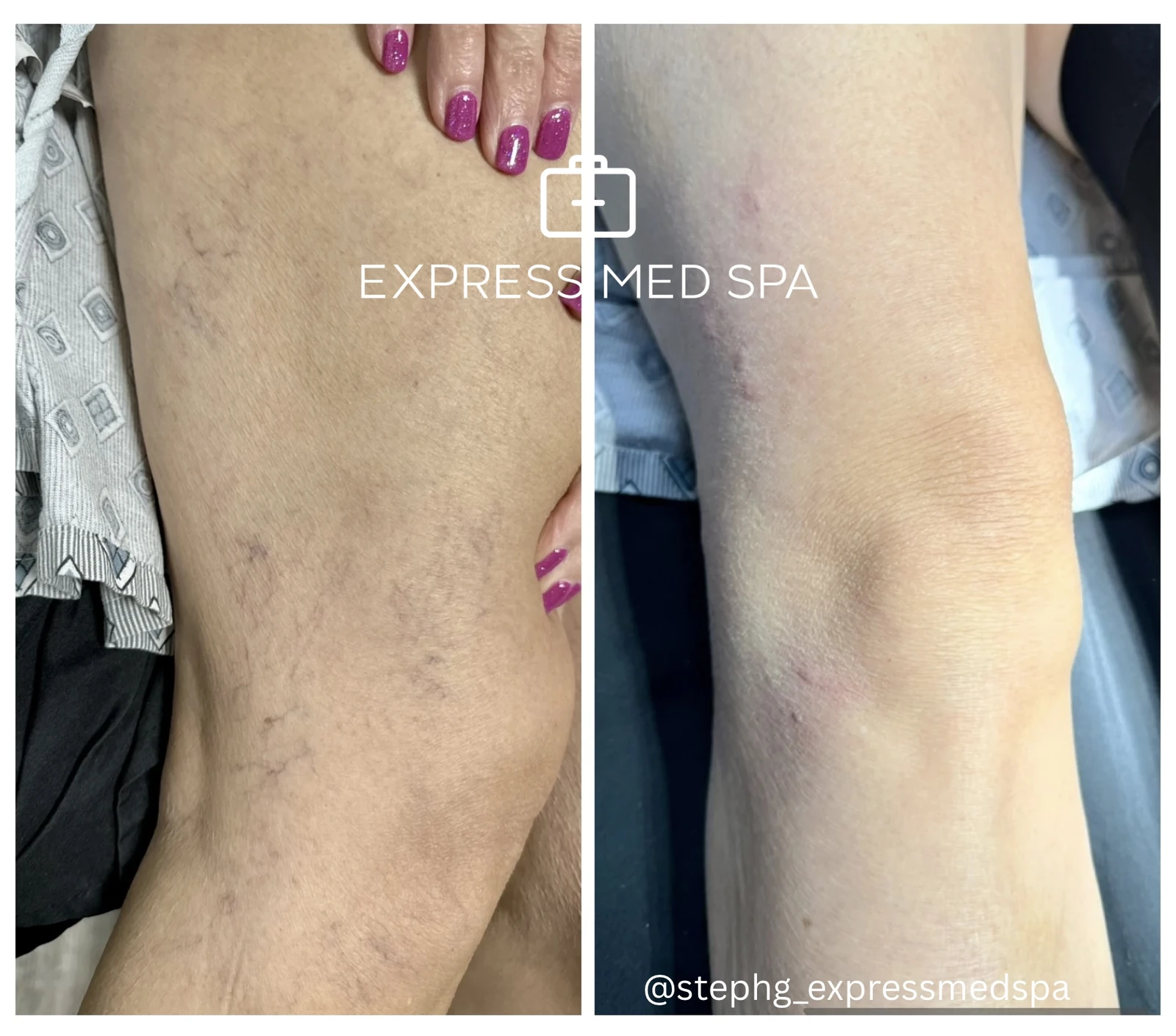 Featured image for “How Much Does Sclerotherapy Cost? Chicagoland Spider Vein Pricing”