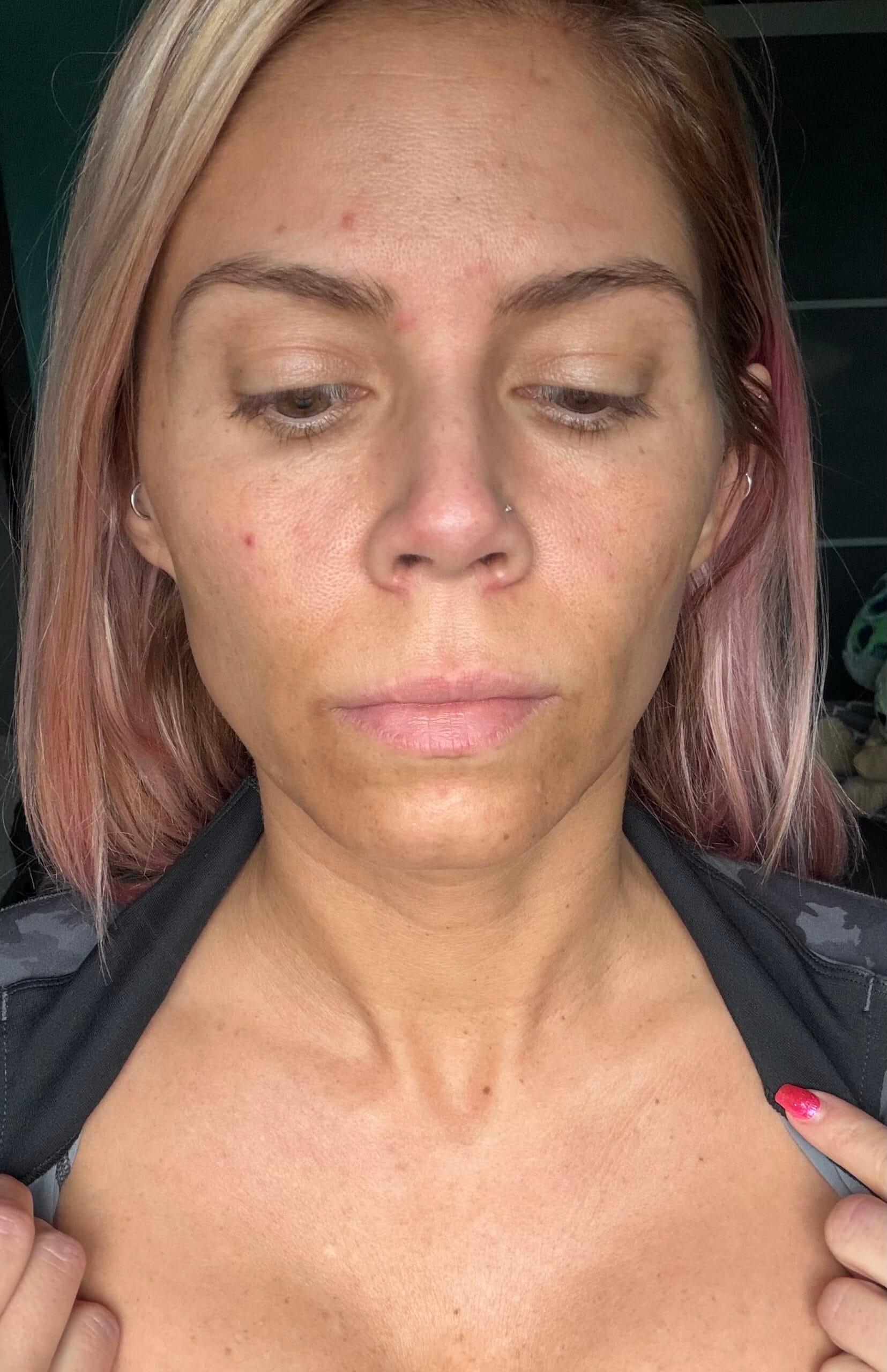 Facial skin before a chemical peel skin resurfacing treatment at Express Med Spa in Illinois, showing the pre-treatment skin tone and texture.