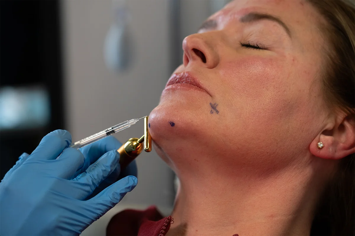 Licensed injector performing a precise Botox cosmetic injection on a patient at Express Med Spa in Chicagoland Illinois