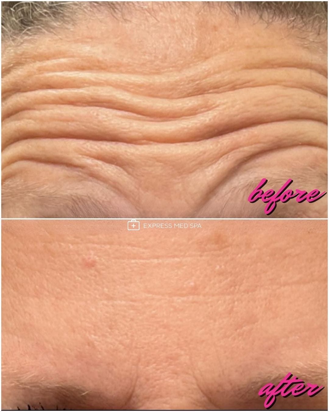 Before and after Botox treatment for forehead lines and frown lines at Express Med Spa La Grange, near Hinsdale and Clarendon Hills Illinois