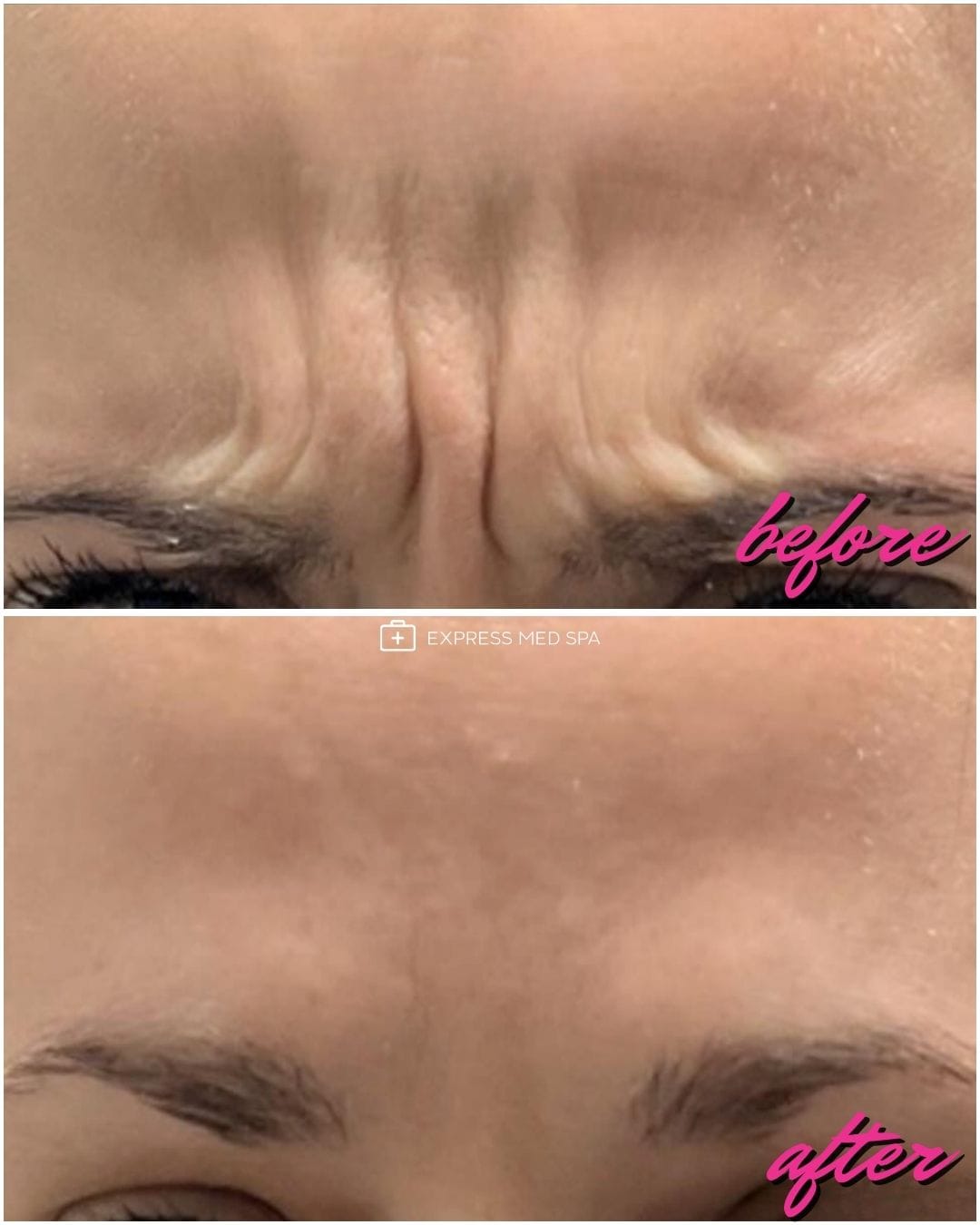 Planning Botox treatment goals with a nurse injector at Express Med Spa Frankfort