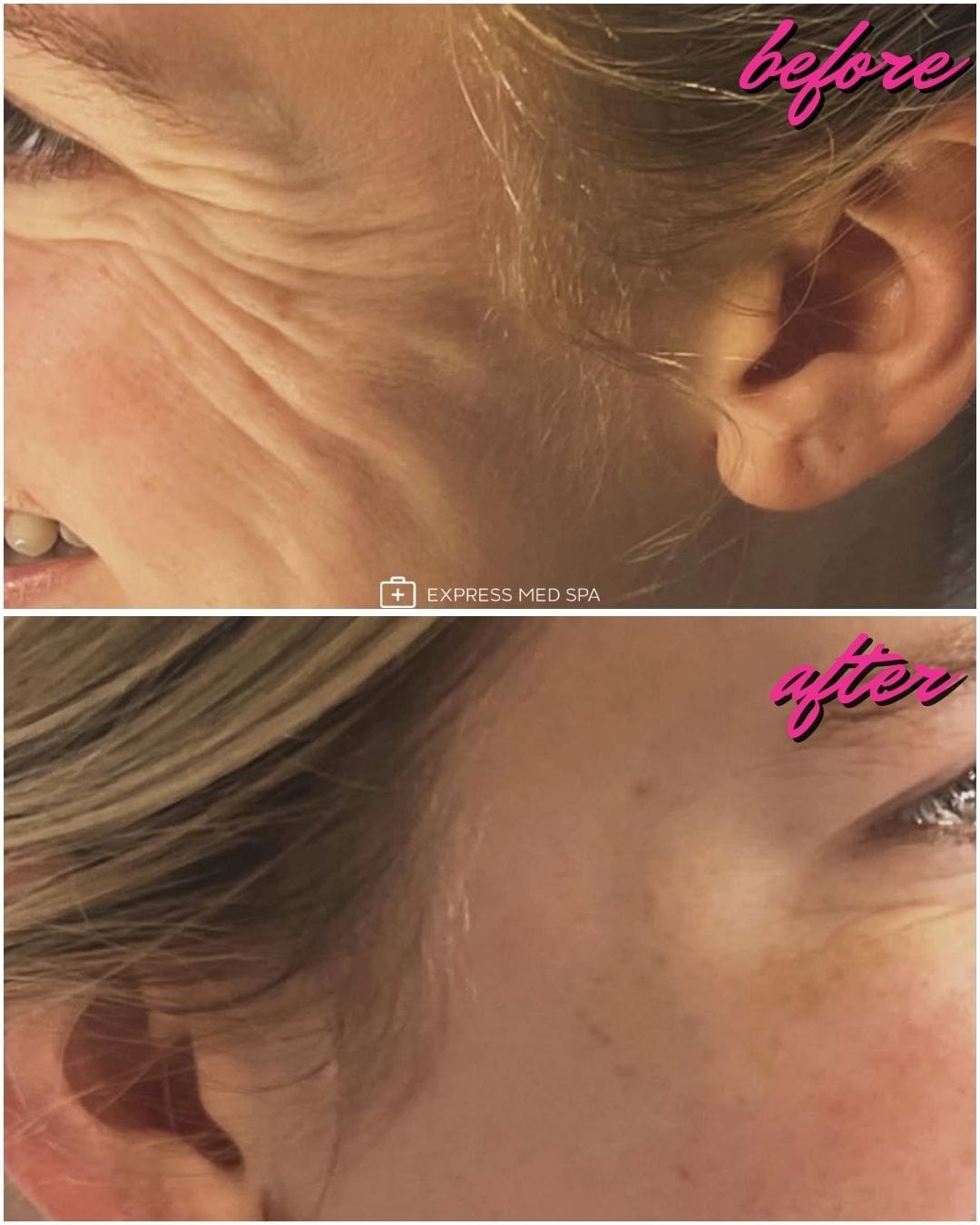 Botox aftercare for smooth, refreshed results at Express Med Spa Frankfort