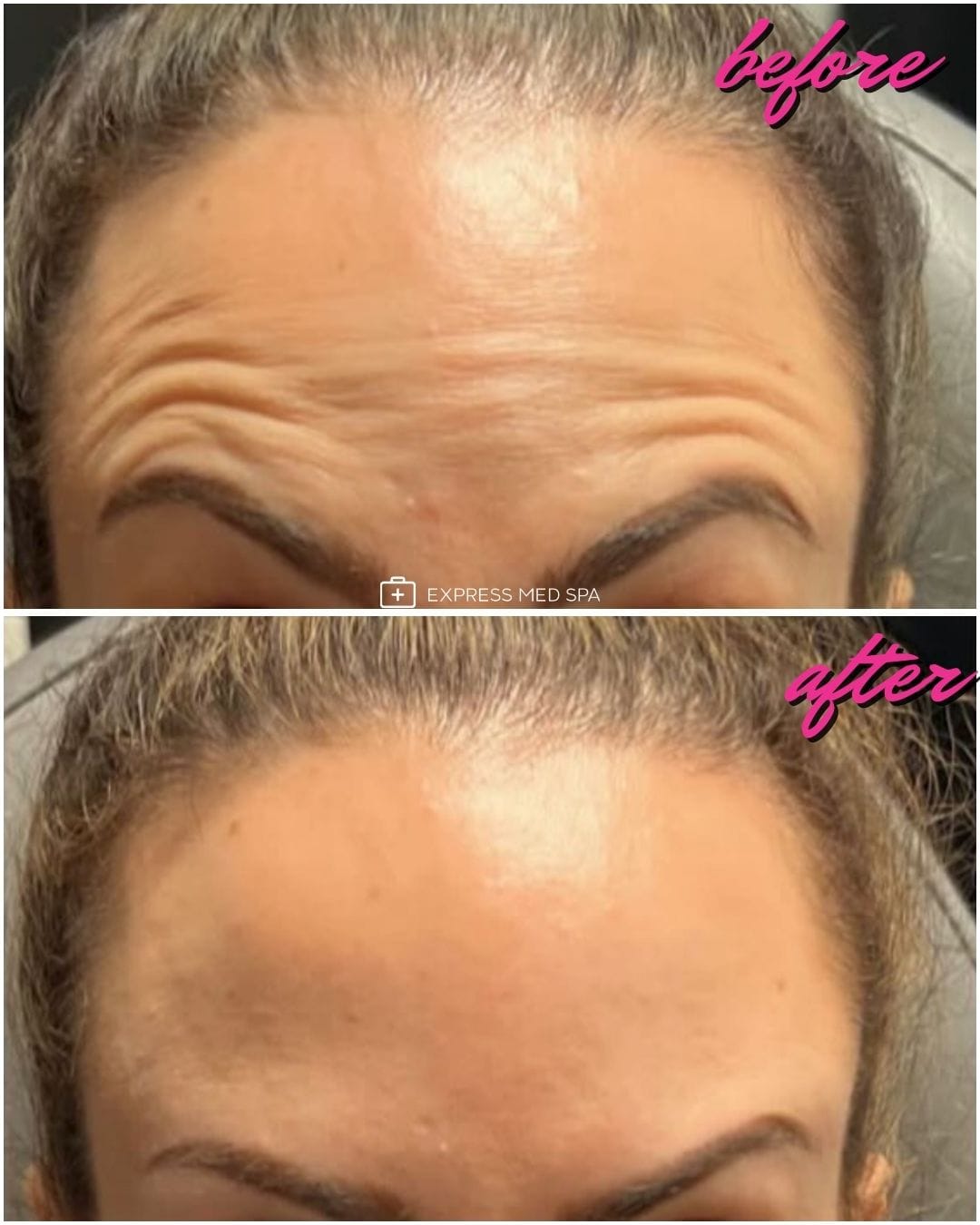 What to expect at a Botox appointment at Express Med Spa Frankfort