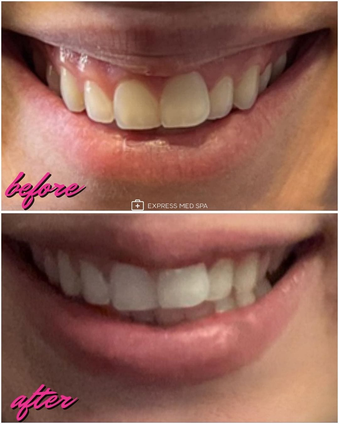 Before and after Botox treatment for gummy smile at Express Med Spa showing improved smile balance with 4 units of neurotoxin.