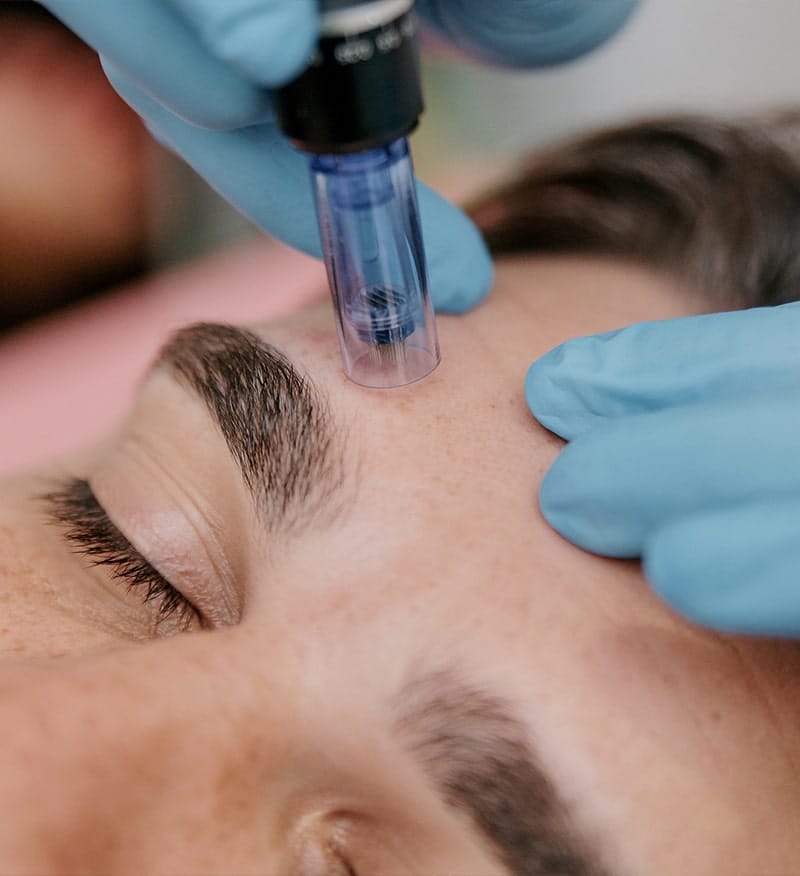 Close-up of Nano Tip Microdermabrasion using CytoPen® S2 at Express Med Spas in Frankfort, IL. Non-invasive skin resurfacing for clarity and texture improvement.