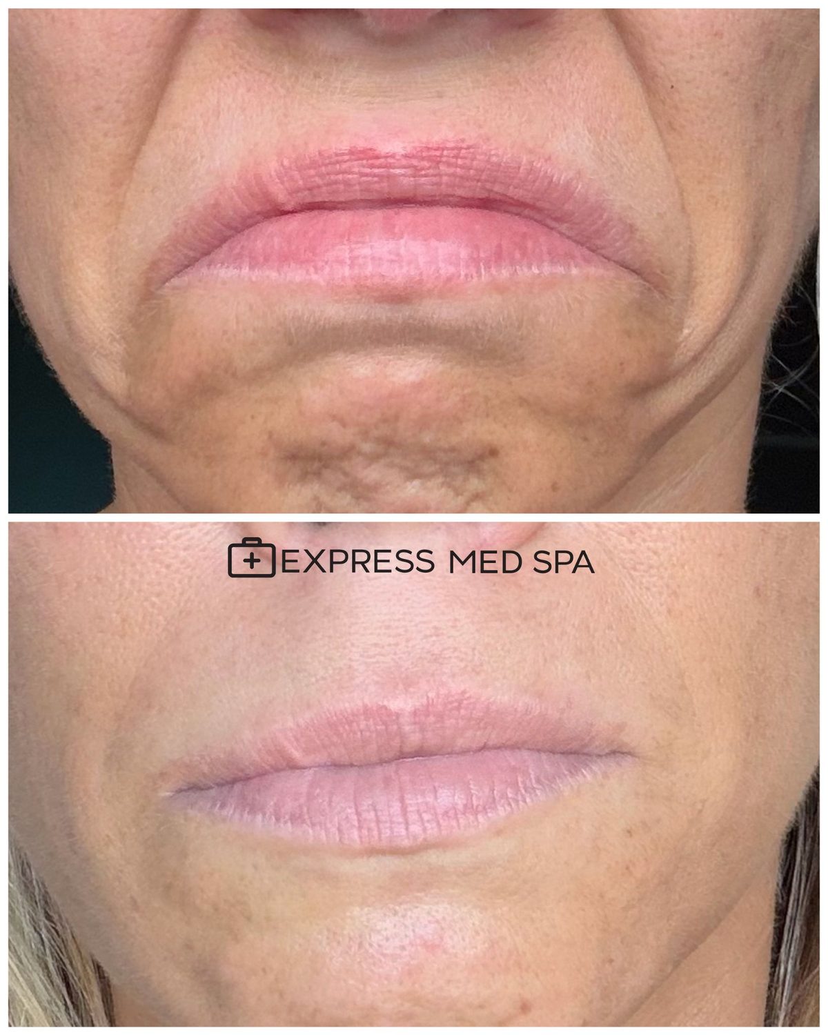 Featured image for “DAO Botox for a Downturned Mouth: What It Lifts, and What It Can’t”