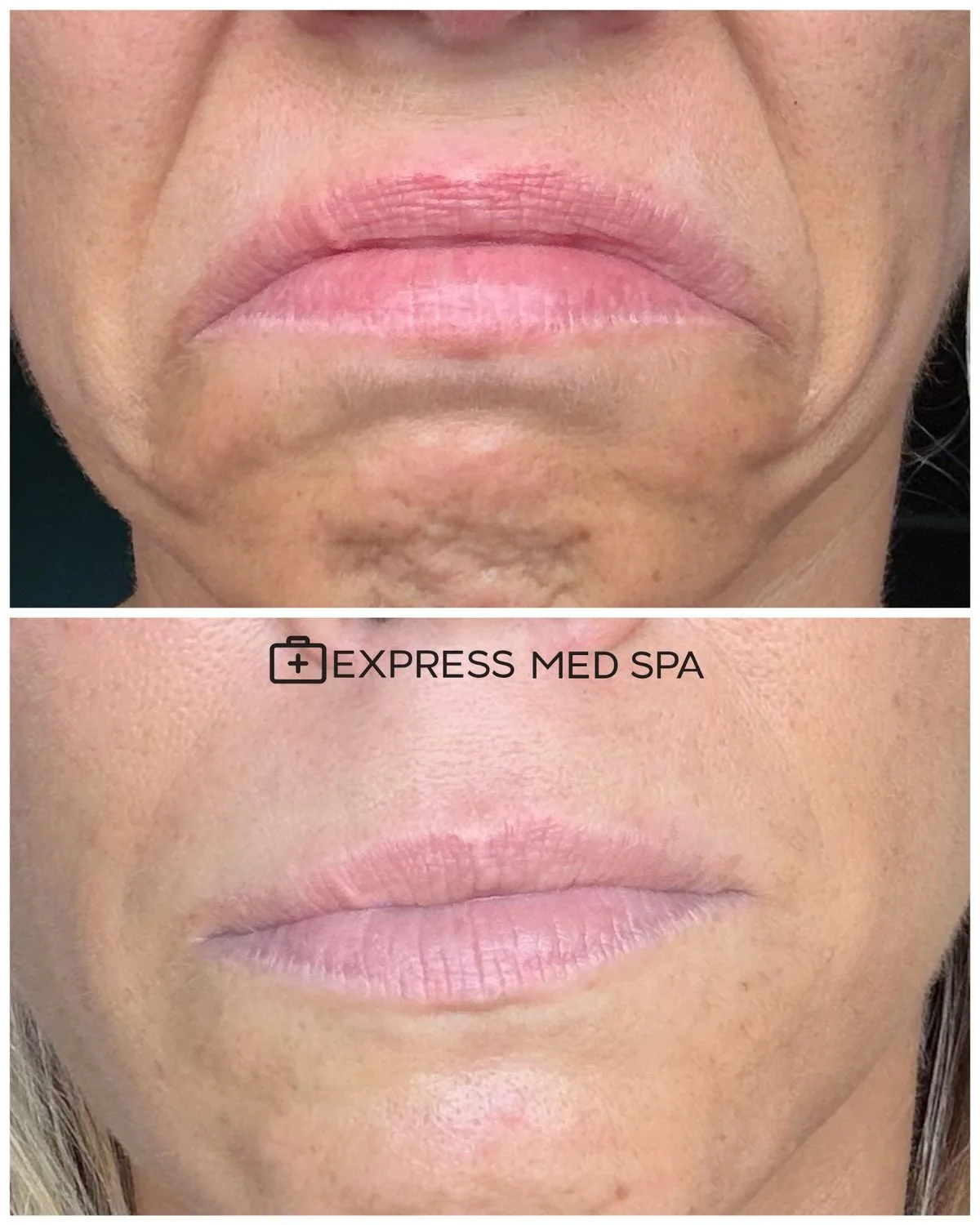 Featured image for “DAO Botox for a Downturned Mouth: What It Lifts, and What It Can’t”