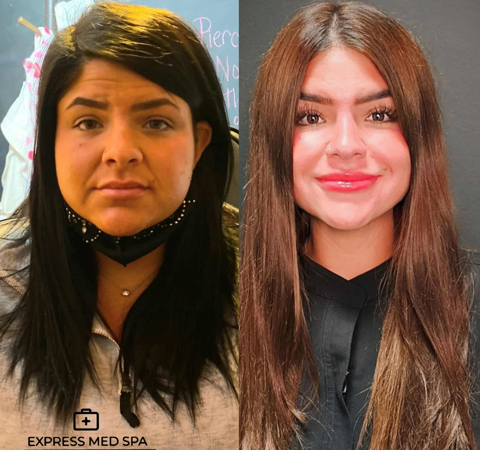 Featured image for “Dermal Filler and Microneedling Facial Rejuvenation, Shorewood IL”