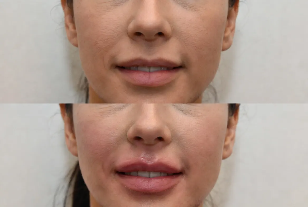 Natural-looking lip filler results after treatment using Revanesse Versa at Express Med Spa La Grange showing subtle volume enhancement and hydrated lips