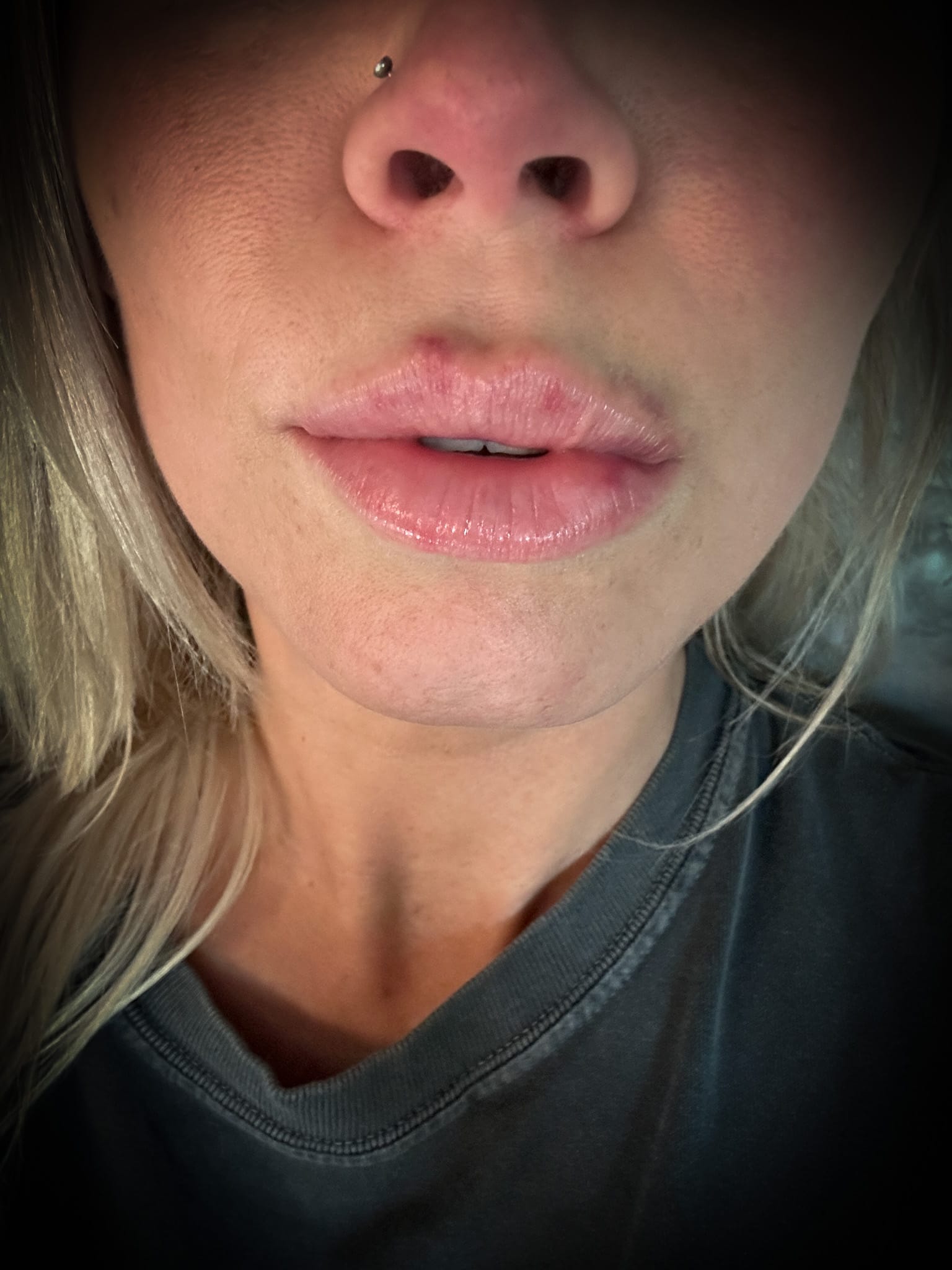 Illustration of lip healing stages after filler injection