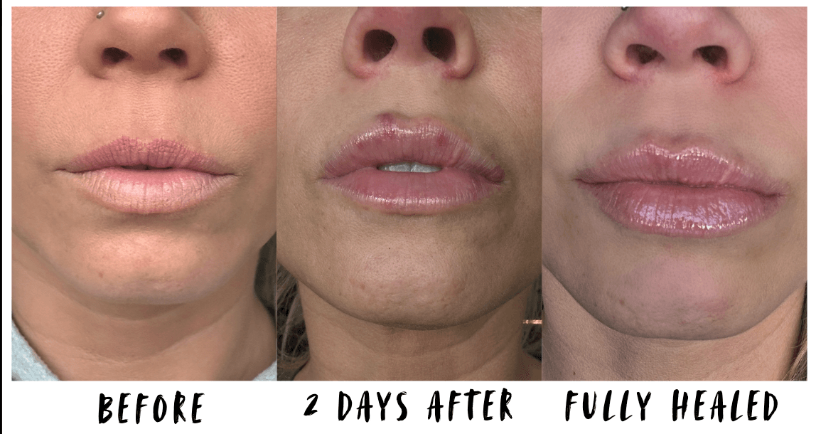 Lip filler before and after showing swelling on day 2 and full healing at 2 weeks