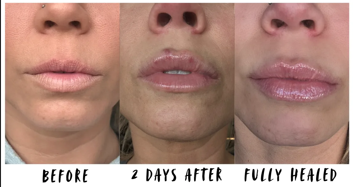 How Long Does Lip Filler Swelling Last? A Frankfort Med Spa Guide How Long Does Lip Filler Swelling Last? A Frankfort Med Spa Guide