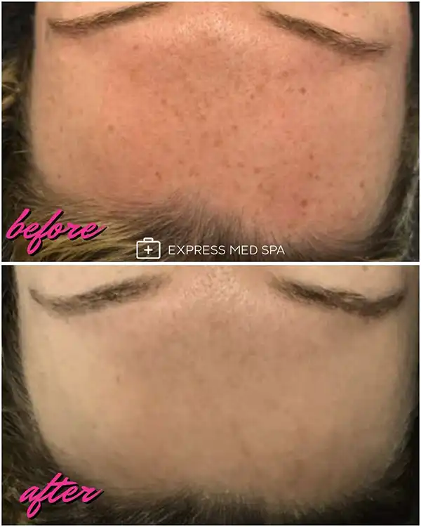 Before and after IPL photofacial results showing sun spot removal on forehead at Express Med Spa Frankfort IL