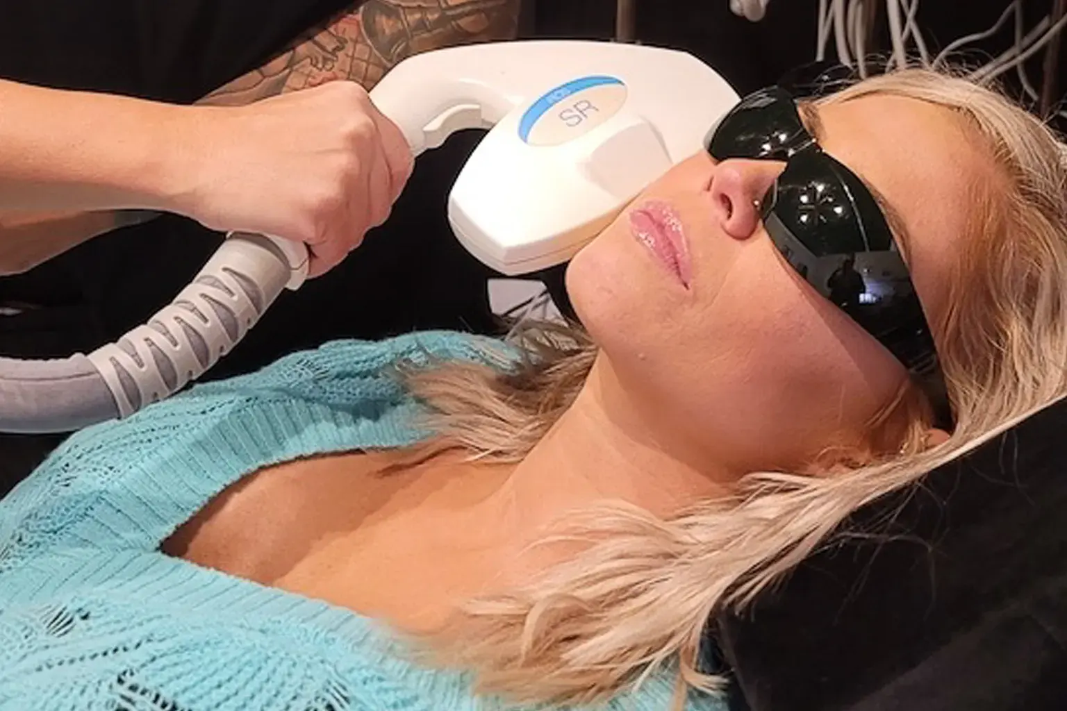 Clinician guiding a Candela elos SR applicator along a patient's cheek during an IPL photofacial at Express Med Spa in Shorewood, IL, with protective eyewear in place.