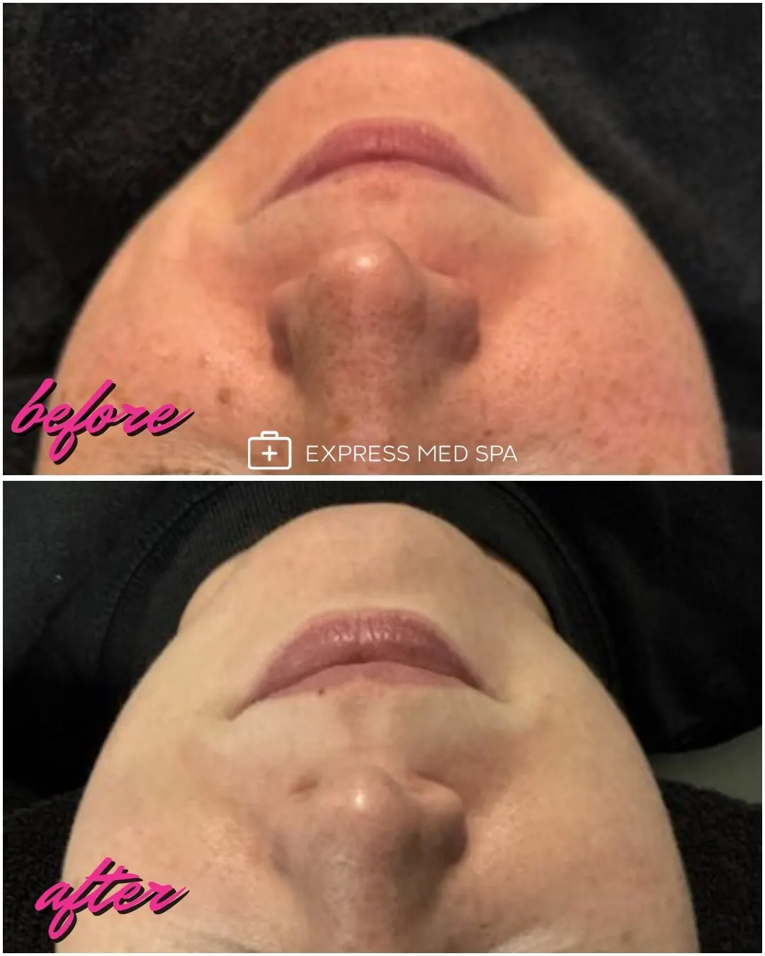 IPL photofacial before and after in Shorewood IL improving sunspots and facial redness for local Will County clients