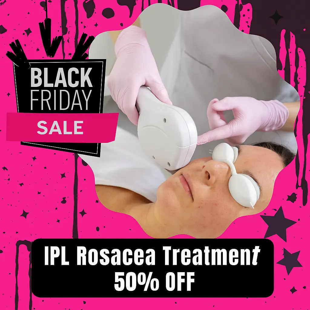 Black Friday 50% off IPL Rosacea Treatment reducing redness and vascular areas at Express Med Spa