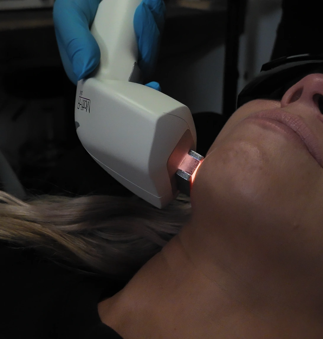 Client receiving facial laser hair removal at Express Med Spa in Manteno, IL, a good fit for medium to dark hair