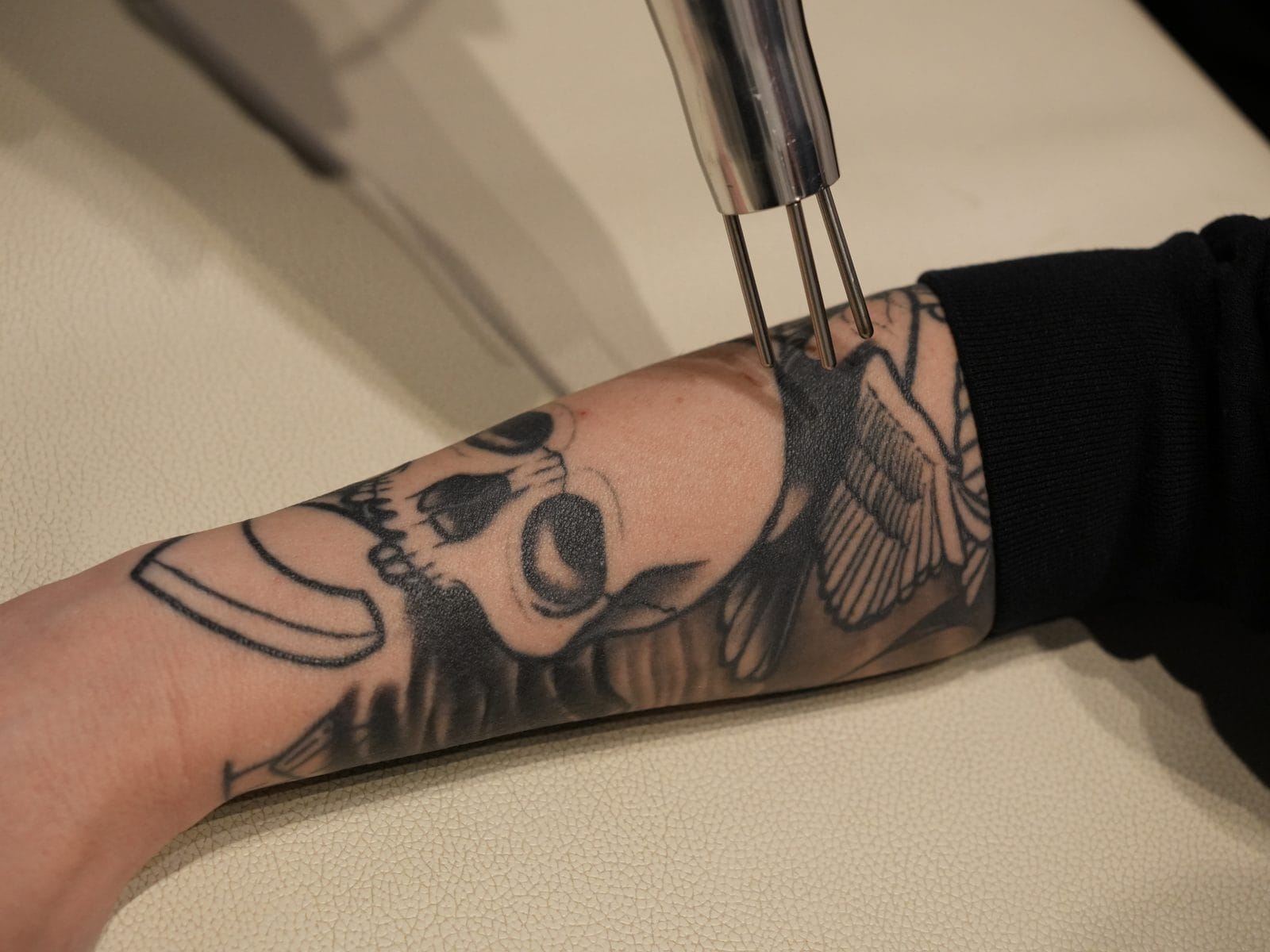 does glutathione fade tattoos How Much Laser Tattoo Removal Cost? 2026 Guide WEIGHT:10/10 MG best bpc 157 manufacturer Master antioxidant supplement