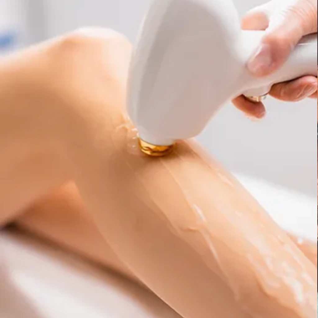 Laser hair removal on legs for ideal candidates with medium to dark hair