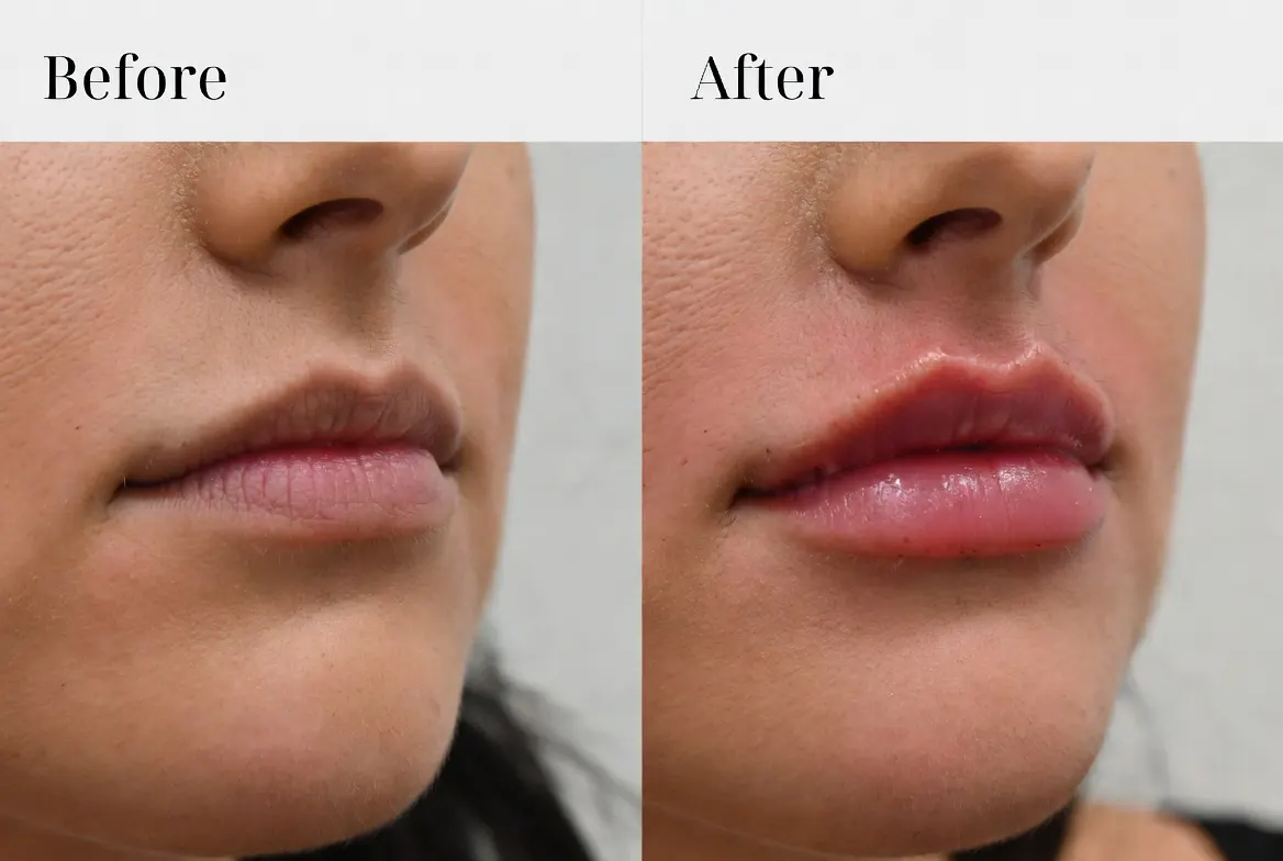 Revanesse Versa+ filler product shown at Express Med Spa Mount Greenwood Chicago, highlighting versatility and premium quality