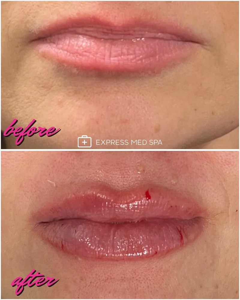 Before and after lip filler at Express Med Spa, showing added volume and a more defined cupid's bow