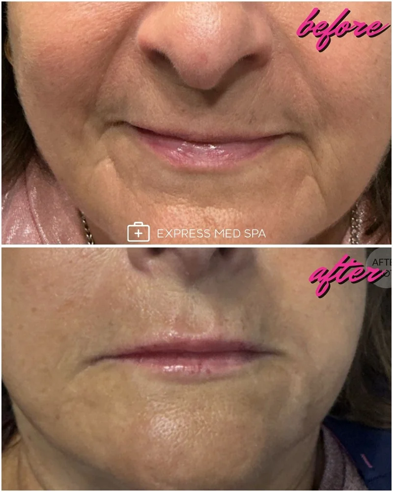 Before and after lip filler at Express Med Spa on a mature client, showing softened vertical lines around the mouth and added lip definition