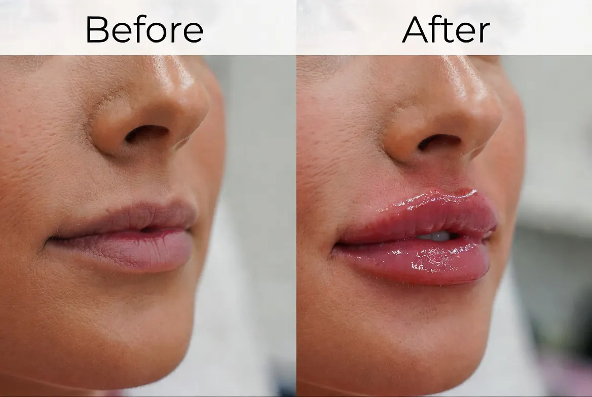 Revanesse Versa and Lips filler boxes displayed together at Express Med Spa Mount Greenwood Chicago, showing premium quality and excitement for natural results