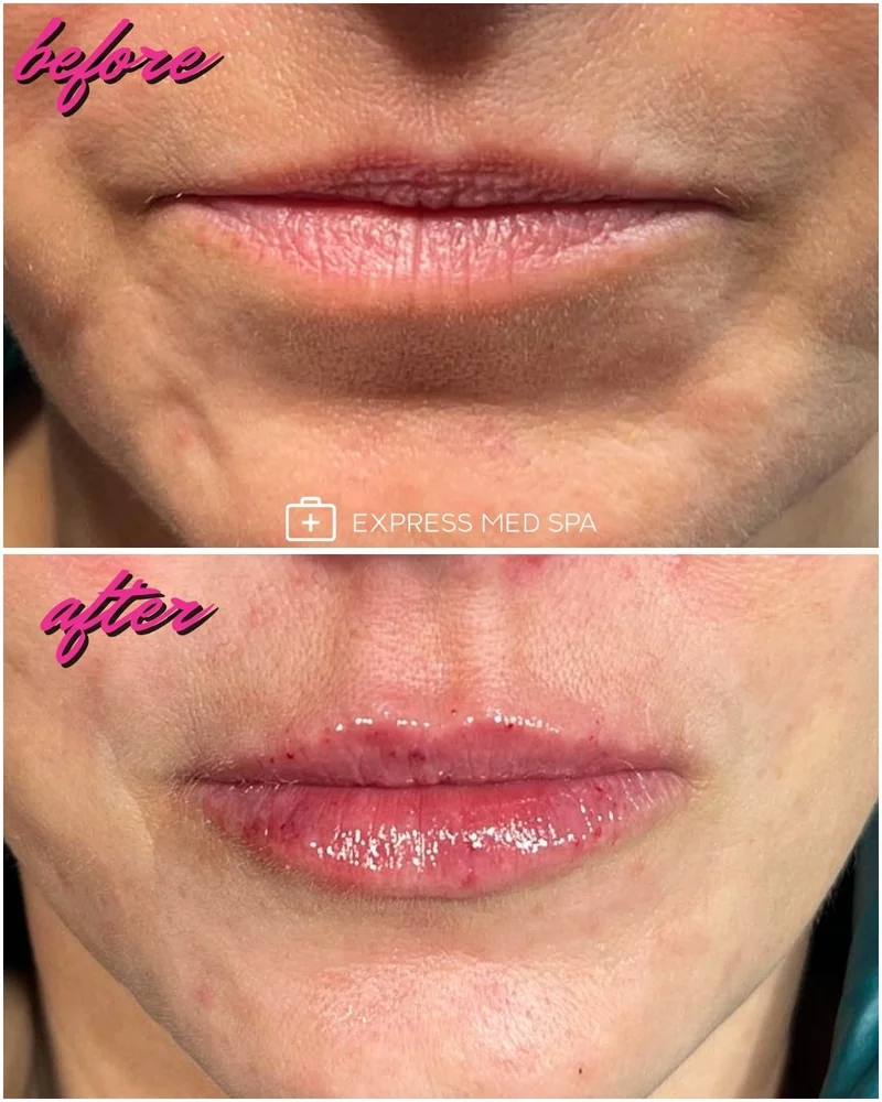 Before and after lip filler at Express Med Spa, showing flat lips with vertical lip lines before and fuller, more everted lips with a defined border after