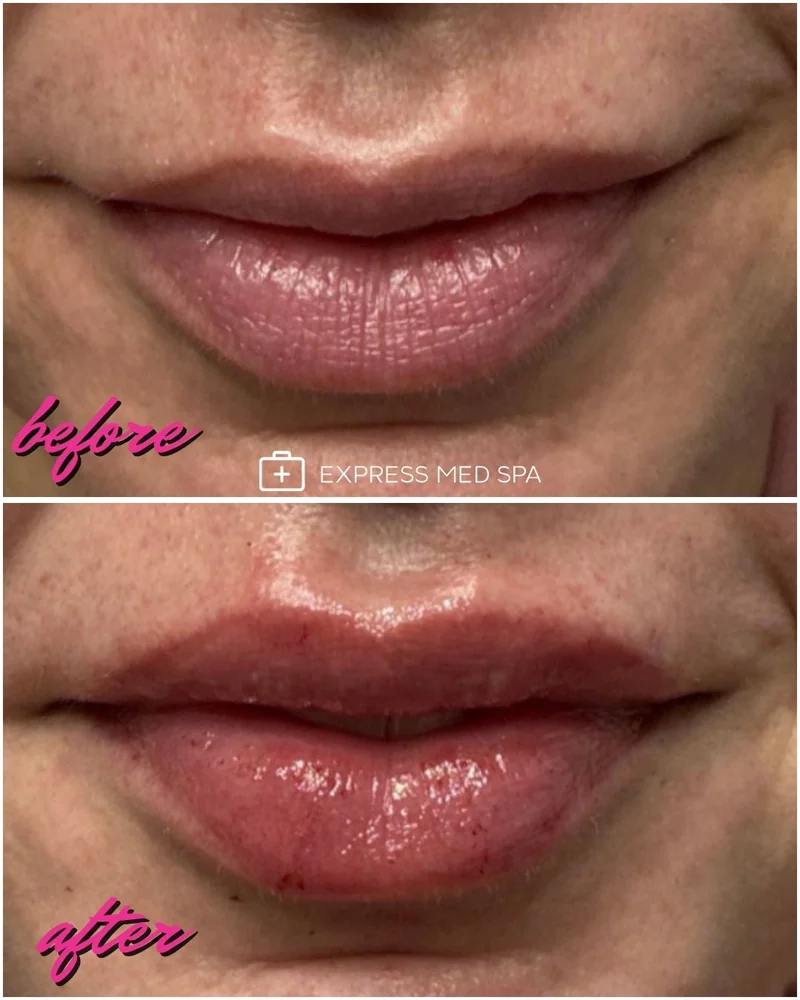 Before and after lip filler at Express Med Spa, showing smoother lip texture and a more defined lip border