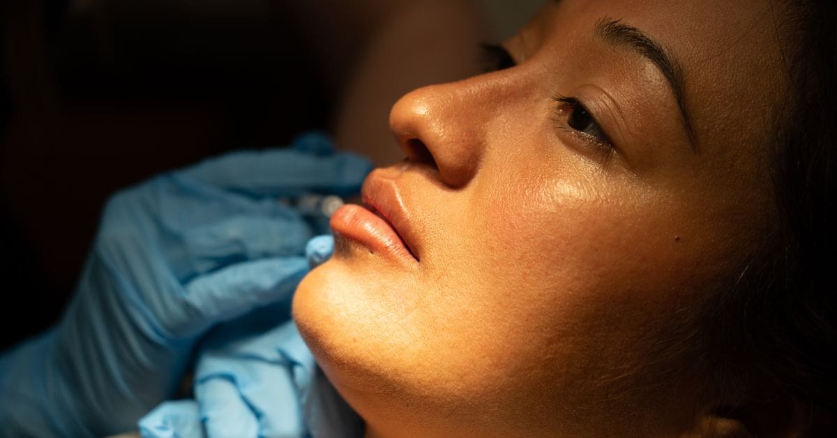 Close-up of a client receiving lip filler at Express Med Spa to enhance volume and define lips for a youthful, rejuvenated look.