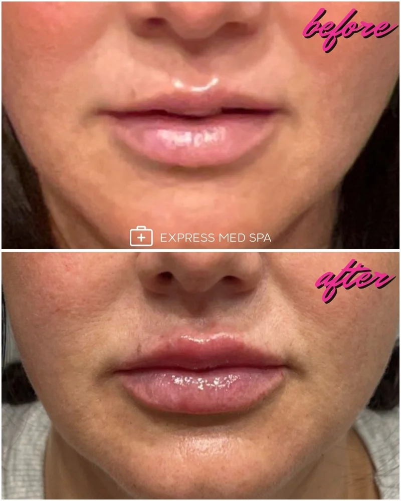 Before and after one syringe of lip filler at Express Med Spa, showing increased upper and lower lip volume