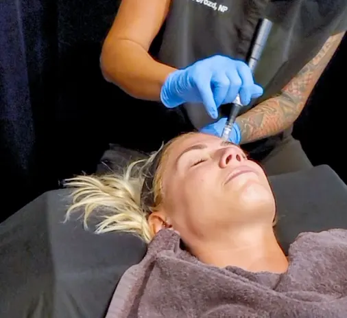 Microneedling