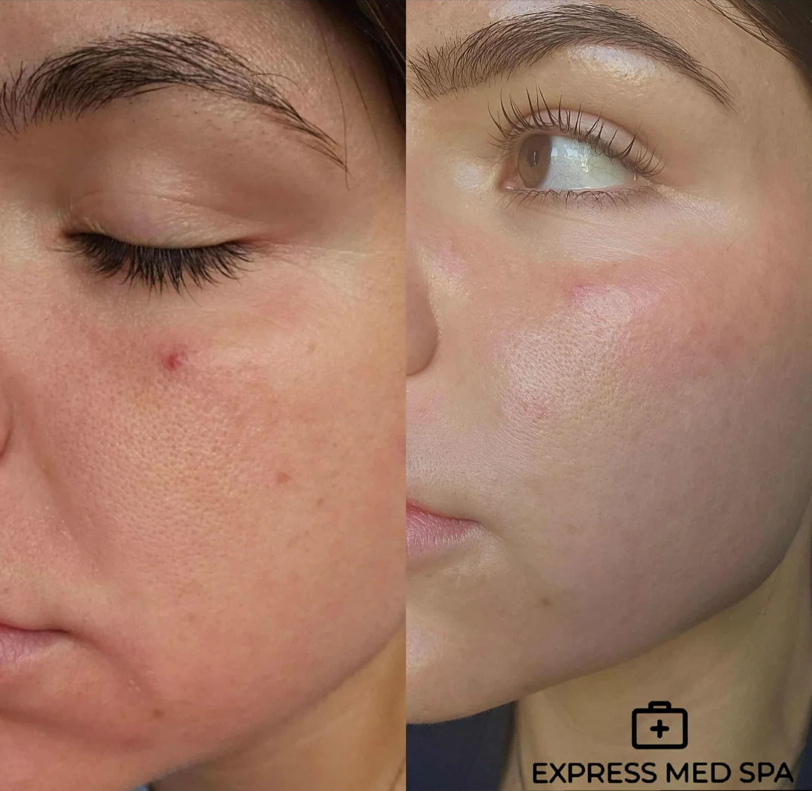 Before and after microneedling at Express Med Spa in Illinois, showing cheek skin texture before treatment on the left and smoother, clearer skin after two sessions on the right.