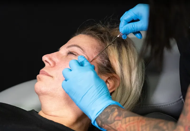 Patient receiving PDO thread lift in the cheek and temple area at Express Med Spa La Grange, IL, performed by a licensed provider with blue gloves.