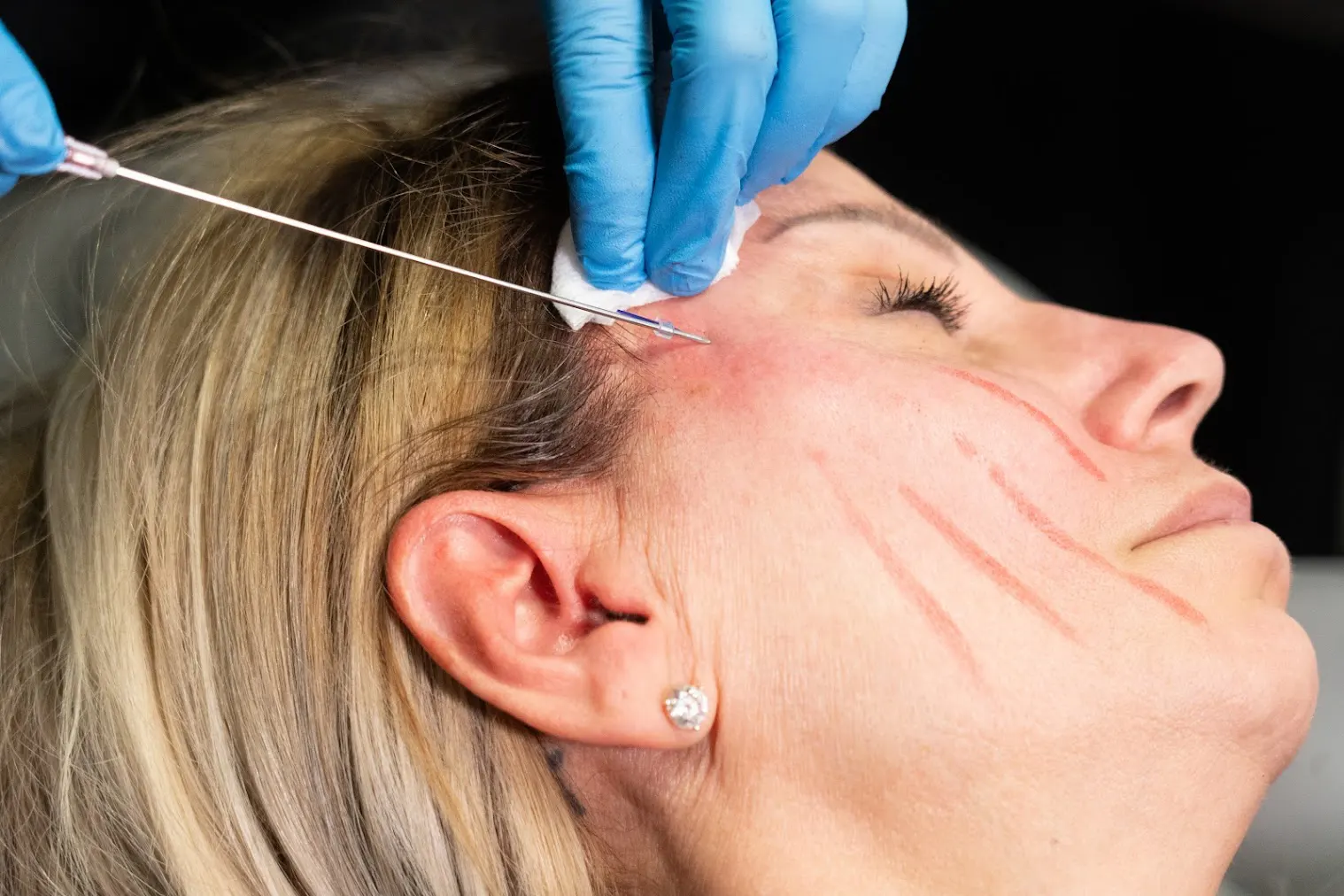 PDO thread lift being performed to lift and tighten facial skin while stimulating collagen at Express Med Spa. How Do PDO Threads Stay in Place