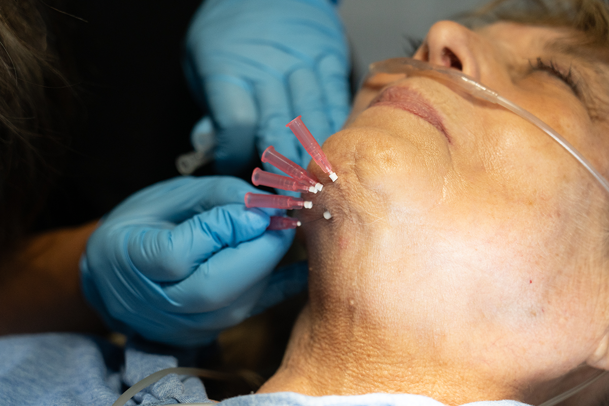 Multiple PDO threads inserted in jawline and neck area during thread lift procedure at Express Med Spa showing facial contouring technique. How Do PDO Threads Stay in Place