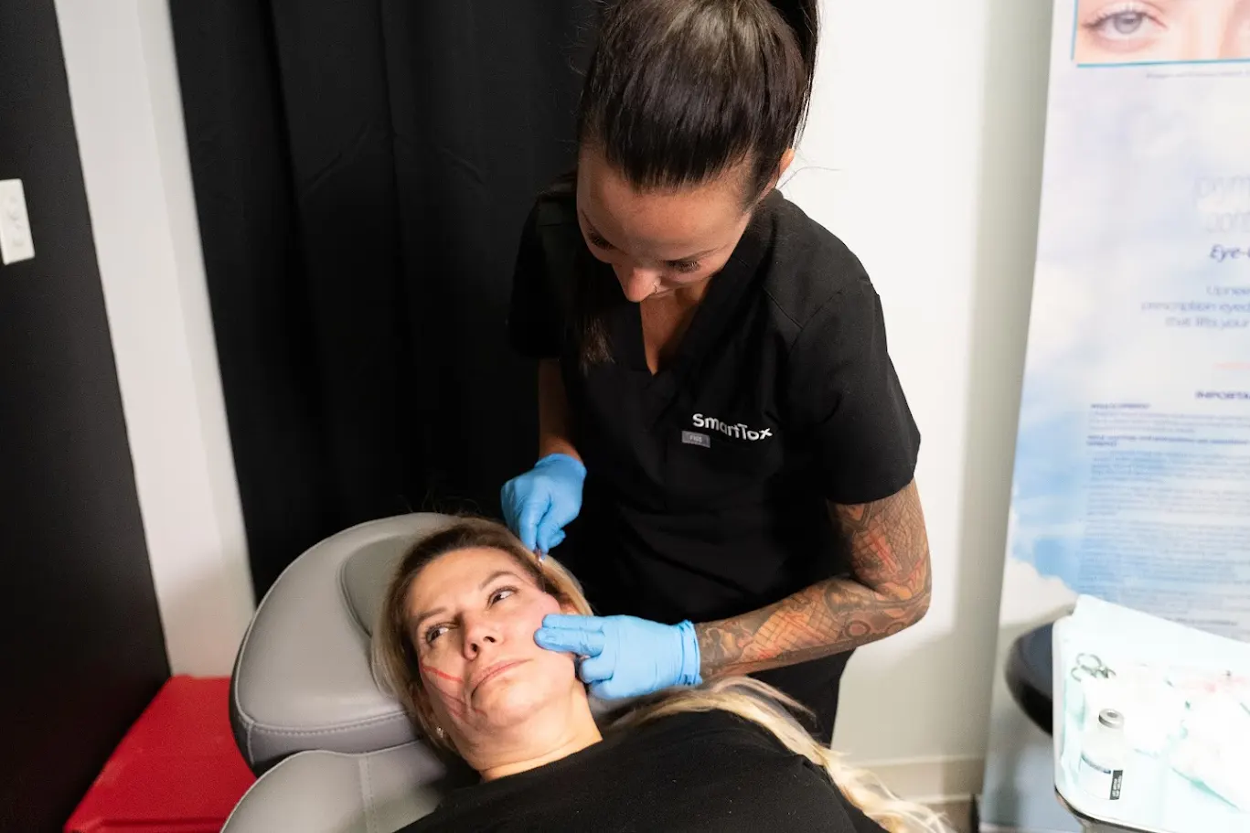 PDO thread lift in Shorewood IL enhancing cheek and midface with collagen-stimulating sutures.