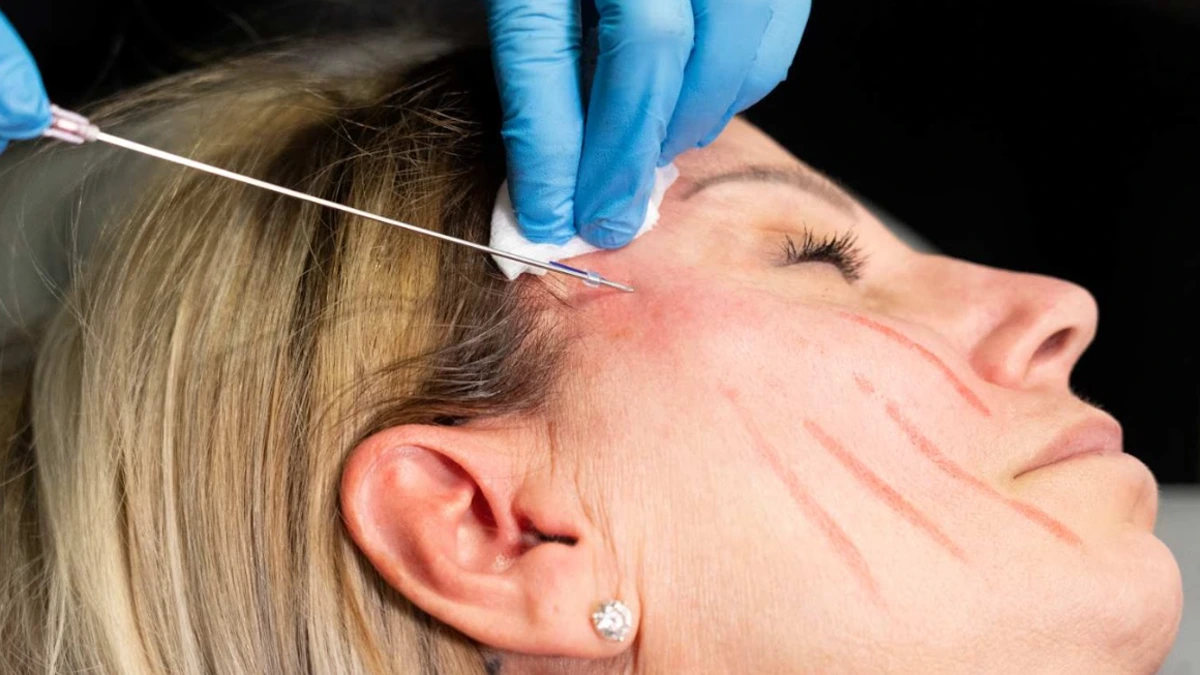 PDO thread lift treatment being performed at Express Med Spa to lift facial contours