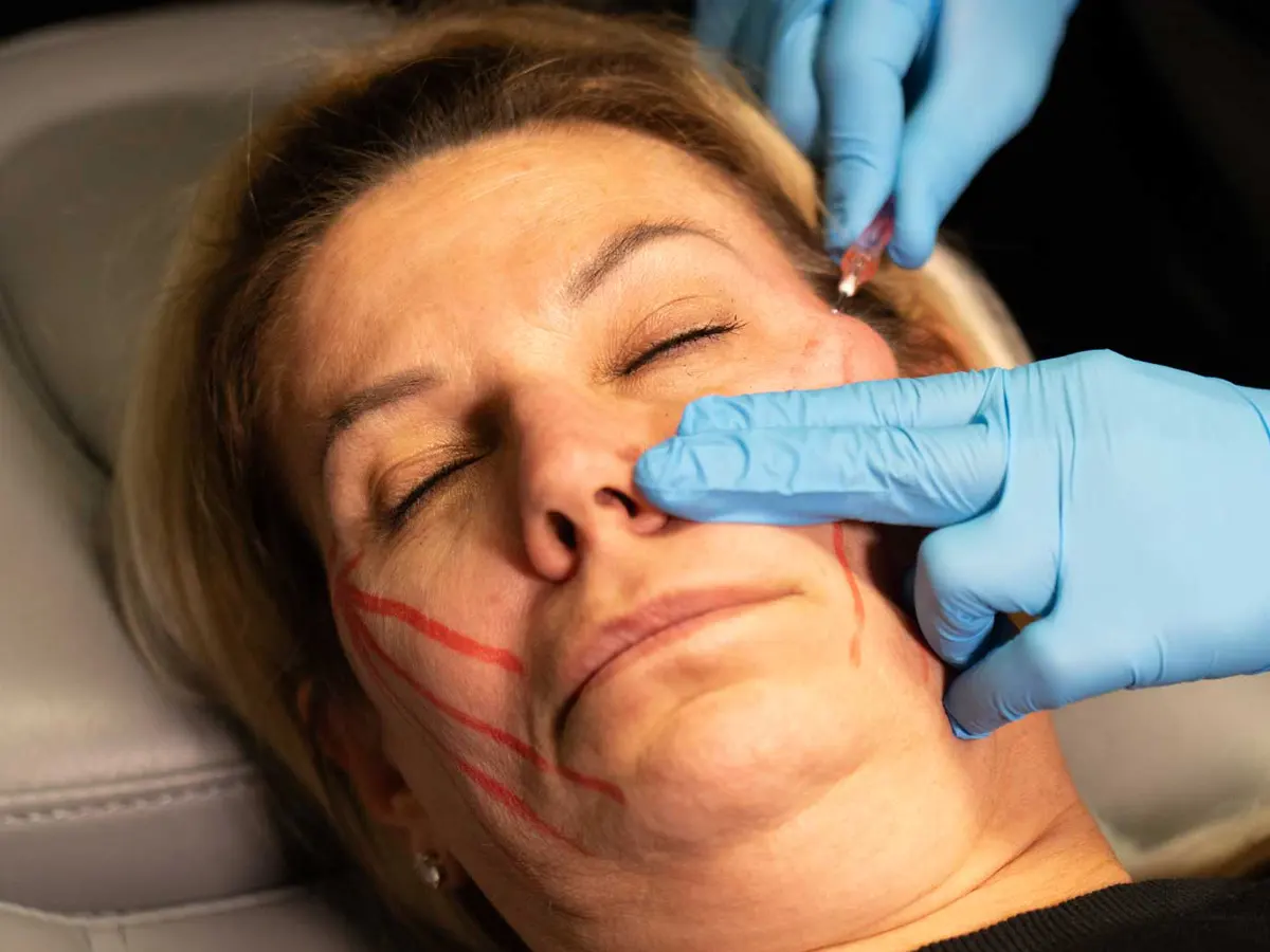 PDO thread lift treatment in Shorewood IL lifting and contouring the cheeks and jawline for a firmer, youthful appearance