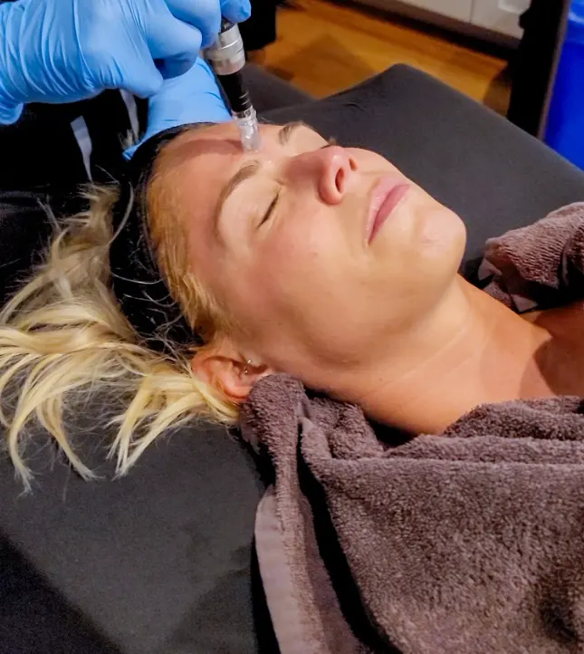 Platelet-rich plasma applied after microneedling to enhance skin regeneration at Express Med Spas in Will County.