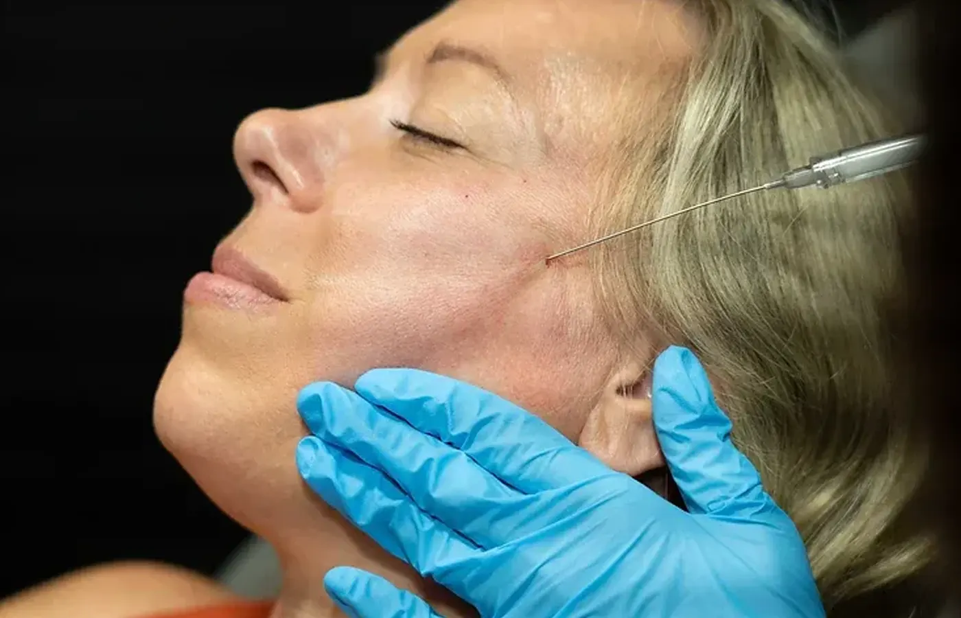 Radiesse treatment areas: nasolabial folds, marionette lines, jawline, chin, hands