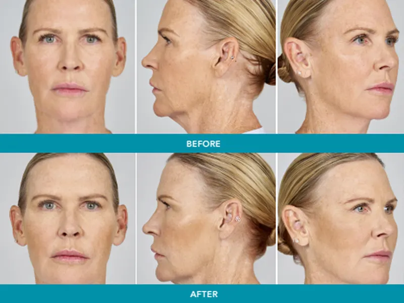 Before and after Radiesse filler showing improved volume, smoother jawline, and natural collagen boost at Express Med Spa Chicago.