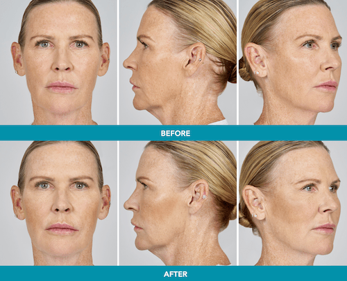 Before and after Radiesse facial volume restoration at Express Med Spa Frankfort, IL, shown in three views with the before results on top and after results below.